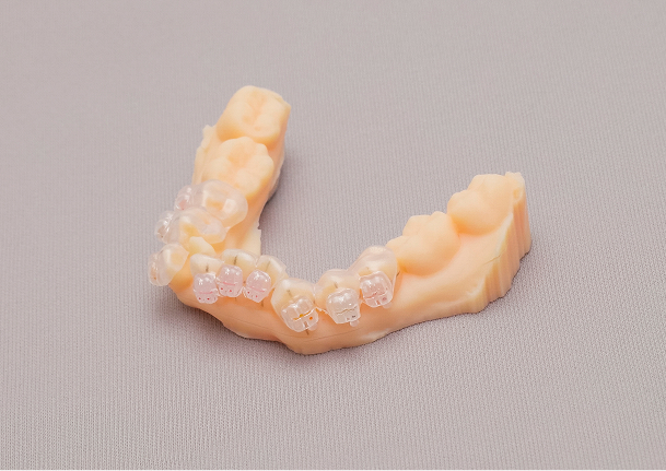 インダイレクトボンディングイメージ