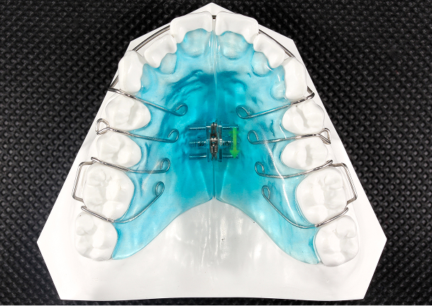 拡大床（上顎）イメージ