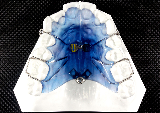 Fanタイプ拡大床（Dentaurum)イメージ