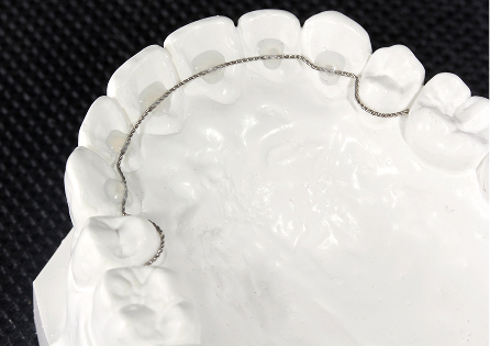 ボンディングリテーナー
（レジンベース）イメージ4