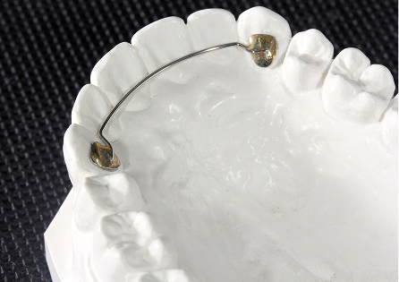 ボンディングリテーナー
（メタルベース）イメージ4